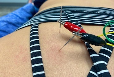Dry needling treatment with electrical stimulation applied to a patient's back