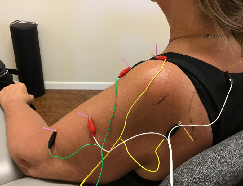 Dry needles placed in a shoulder