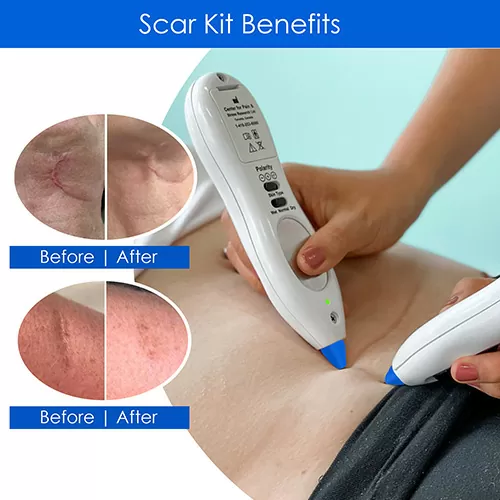 C-section scar release therapy results