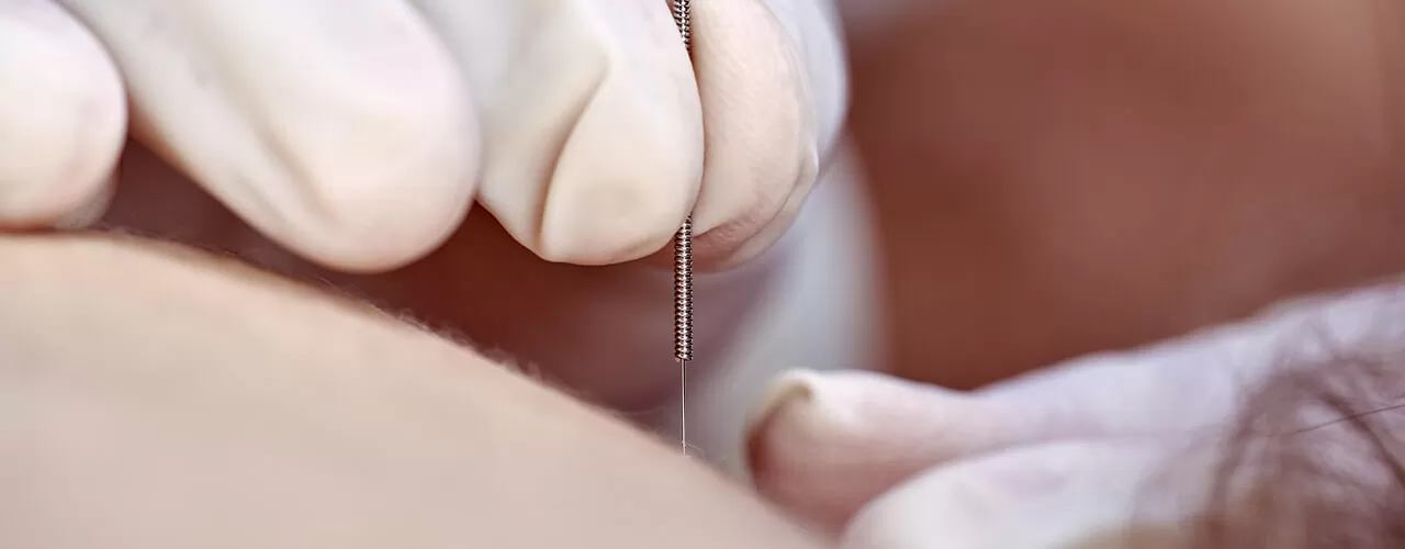 Dry needling treatment