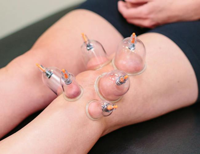 Cups placed on a patient’s back during a physical therapy session