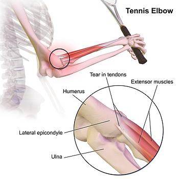 Illustration of elbow pain