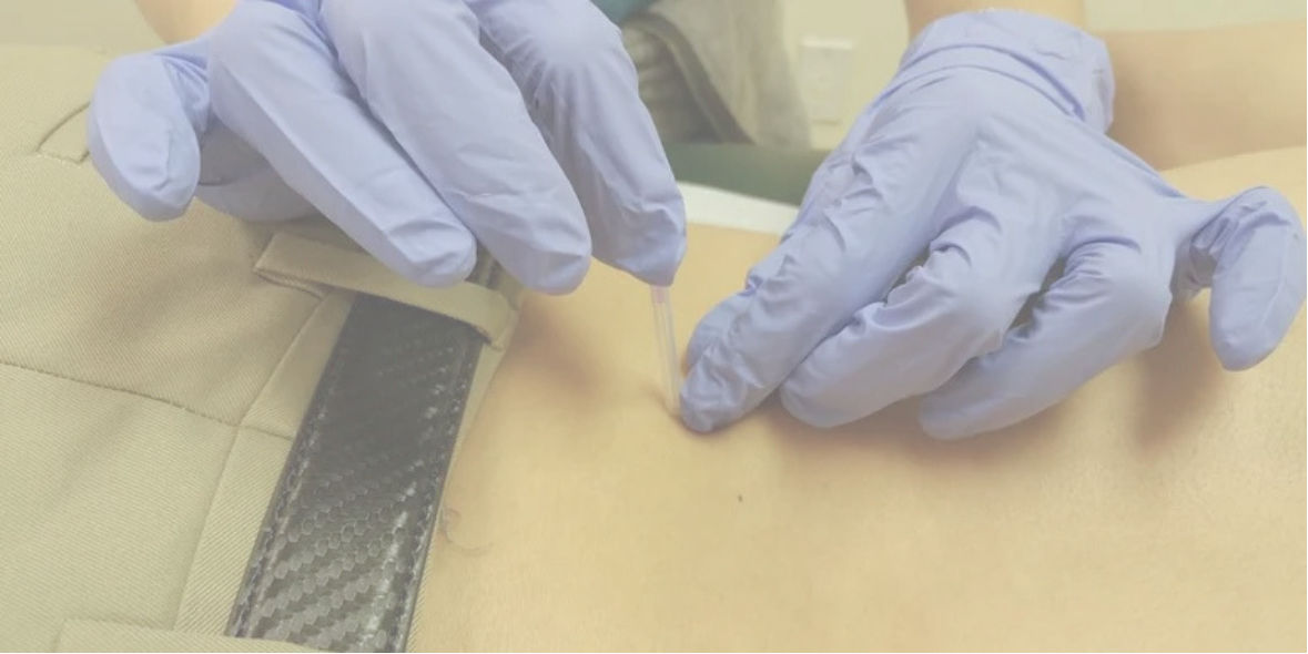 Dry needling therapy