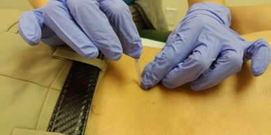 Dry Needling treatment