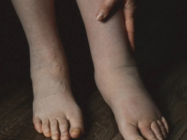 Lymphedema | Resolute Physical Therapy | Physical Therapy in Mount Joy, PA